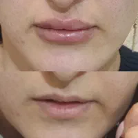 لیزرموهای زائد،ژل،بوتاکس،هایفو،فیشال وپاکسازی پوست|خدمات آرایشگری و زیبایی|کرج, فاز ۴ مهرشهر|دیوار