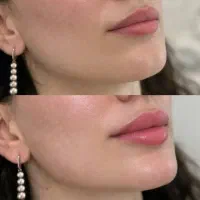 آف ژل لب صورت بیکینی باسن بوتاکس لیفت نخ توسط پزشک