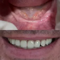 دندان مصنوعی / لابراتوار دندانسازی / پروتز متحرک