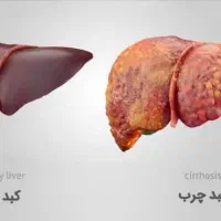 کمک به بهبود کبد چرب