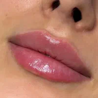 مدل برای فیلتر .بوتاکس.خدمات پوستی