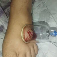 درمان کمرگردن ماساژ حجامت