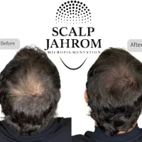 میکرواسکالپ سر