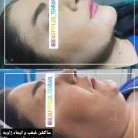 ساکشن غبغب وتزریق چربی بصورت و هرناحیه ازبدن درمطب|خدمات آرایشگری و زیبایی|قم, زنبیل آباد|دیوار