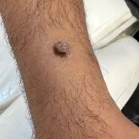 با یک جلسه کک و مکا حذف کن|خدمات آرایشگری و زیبایی|خرم‌آباد, |دیوار