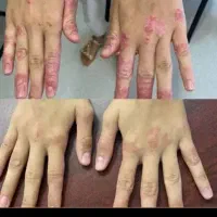 درمان قطعی وبدون بازگشت پوستی|آرایشی، بهداشتی، درمانی|سیرجان, |دیوار