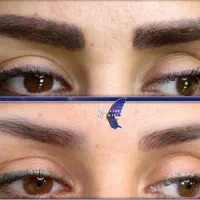 وقتشه که تتو های قدیمی رو پاک کنی