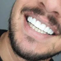 کامپوزیت دندان جشنواره/ترمیم|خدمات آرایشگری و زیبایی|تهران, مرزداران|دیوار