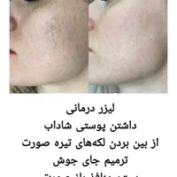 هایفو جوانساز، کیوسوئیچ، ریموو تتو،لیزر موهای زائد|خدمات آرایشگری و زیبایی|آبادان, |دیوار