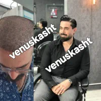 کاشت مو پر تراکم|خدمات آرایشگری و زیبایی|تهران, جردن|دیوار