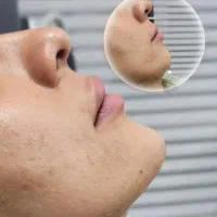 بوتاکس و فیلر صورت برای مدل تحت نظر پزشک|خدمات آرایشگری و زیبایی|زنجان, |دیوار