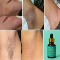 رفع دائم موهای زائد بدون لیزر (پرداخت درب منزل)
