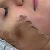 لایه برداری پوست درمان لک