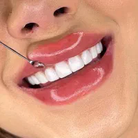 کامپوزیت دندان بدون تراش با ضمانت  ۵ ساله