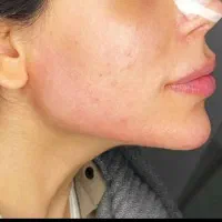 تزریق وآموزش،ژل،بوتاکس،مزوژل زیرچشم،آنزیم ومزو|خدمات آرایشگری و زیبایی|کرج, فاز ۳ گوهردشت|دیوار