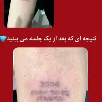 حذف تخصصی تتو بدن و ابرو با جدید ترین دستگاه لیزر