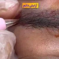 آموزش ریموو تهاجمی و غیرتهاجمی|خدمات آموزشی|کرمانشاه, |دیوار