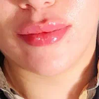 ژل وبوتاکس|خدمات آرایشگری و زیبایی|اهواز, ۲۴ متری|دیوار