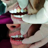 کامپوزیت دندان،روکش دندان،دندانپزشکی ، لمینت دندان|خدمات آرایشگری و زیبایی|اهواز, طالقانی|دیوار