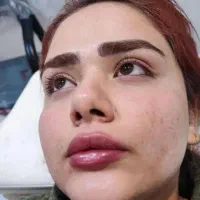 تزریقات ژل و بوتاکس|خدمات آرایشگری و زیبایی|دوگنبدان, |دیوار