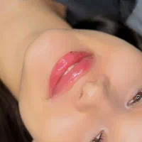 کلیه خدمات زیبایی فیلر (ژل) بوتاکس