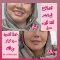 جوانسازی ژل و مزوژل و..|خدمات آرایشگری و زیبایی|برازجان, |دیوار