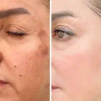 ازبین برنده لک تضمینی
