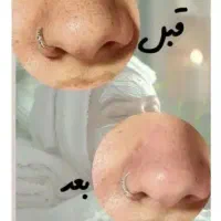 تخفیف لیزرکل بدن فقط۴۵۰ بمناسبت روزمادر تست رایگان|خدمات آرایشگری و زیبایی|زنجان, |دیوار