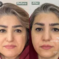 هایفوتراپی رفع چین و چروک پوست با بروزترین تجهیزات|خدمات آرایشگری و زیبایی|شیراز, قدوسی غربی|دیوار