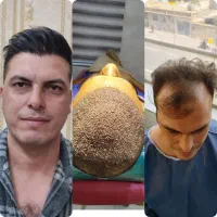 کاشت مو fueپلاس|خدمات آرایشگری و زیبایی|شیراز, قصرالدشت|دیوار