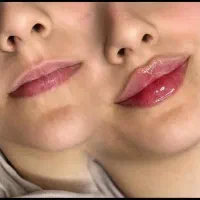 تزریق ژل بوتاکس نخ فیلر توسط پزشک