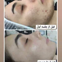 جشنواره تخفیف خدمات پوستی(فیشال،پاکسازی،کربوکسی)|خدمات آرایشگری و زیبایی|بیرجند, |دیوار