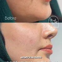 برداشت انواع خال صورت و بدن|خدمات آرایشگری و زیبایی|اهواز, کیانپارس |دیوار