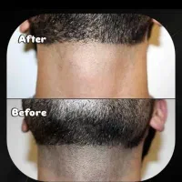 برداشتن انواع خال گوشتی،زگیل،منگوله،کک مک|خدمات آرایشگری و زیبایی|شیراز, شهرک امیر کبیر|دیوار