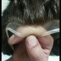 پروتز مو ترمیم