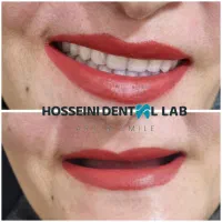 دندانسازی(بلوارهدایت)دندان مصنوعی/دندان سازی|خدمات آرایشگری و زیبایی|مشهد, هدایت|دیوار