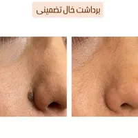 برداشت خال لک و خال گوشتی و زگیل  تضمینی