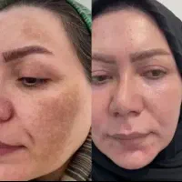 جوانسازی با پی آرپی و لایه برداری پوست  فقط۳۹۹|خدمات آرایشگری و زیبایی|اصفهان, طامه|دیوار