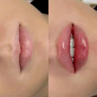 مدل رایگان برای تزریق ژل و بوتاکس-مدت محدود|خدمات آرایشگری و زیبایی|کرج, گلشهر|دیوار