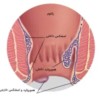 درمان بواسیر،  هموروئید و شقاق