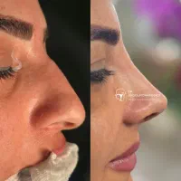 جراحی بینی و پلک، لیفت ابرو و شقیقه، لیفت صورت|خدمات آرایشگری و زیبایی|خوی, |دیوار