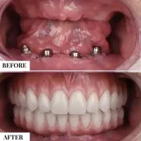 خدمات تخصصی ایمپلنت و اوردنچر دیجیتال