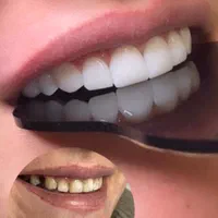 کامپوزیت دندان ،لمینت،بلیچینگ (آف بهاری)|خدمات آرایشگری و زیبایی|اصفهان, خانه اصفهان|دیوار