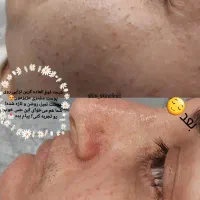 لیزر و کربن تراپی در کلینیک شین