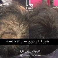 پی آر پیPRP درمان ریزش مو مزوتراپی هیرفیلر کاشت مو|خدمات آرایشگری و زیبایی|تهران, صادقیه|دیوار