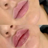 تخفیف ویژه ژل لب، بوتاکس، خط خنده ،گونه زاویه سازی|خدمات آرایشگری و زیبایی|پرند, فاز ۵|دیوار