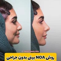 فرمدهی صورت بینی بدون جراحی بیهوشی پکیج یانگ فیس|خدمات آرایشگری و زیبایی|مشهد, هفت تیر (حافظ)|دیوار