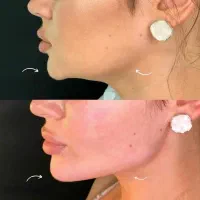 جشنواره ژل و بوتاکس با قیمت باورنکردنی/اقساط|خدمات آرایشگری و زیبایی|آمل, |دیوار