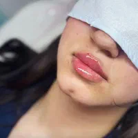 فول فیس و بوتاکس و فیلرتوسط پزشک