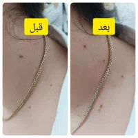 برداشتن خال و انواع ضایعه پوستی|خدمات آرایشگری و زیبایی|گرگان, |دیوار